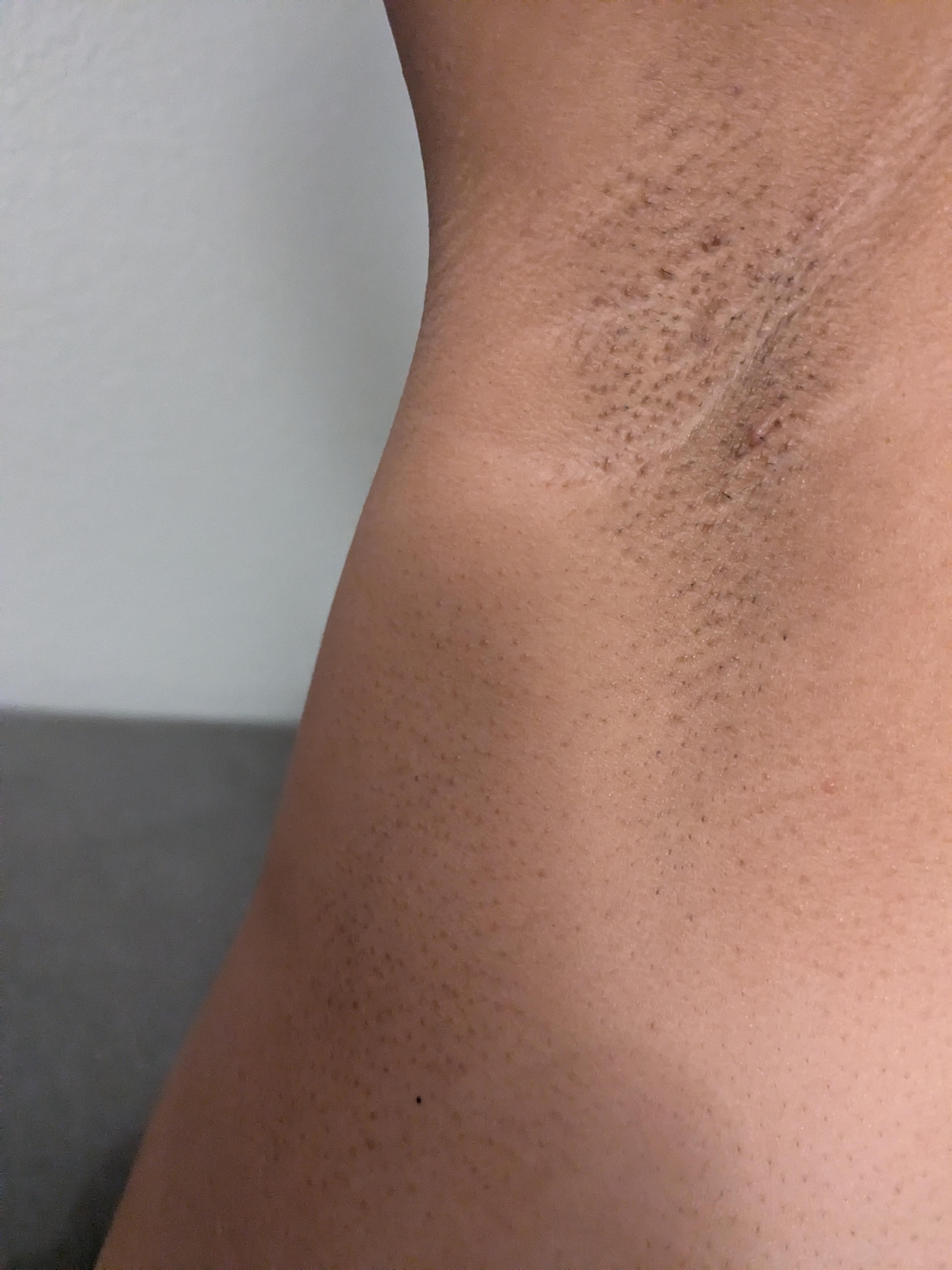 ぶつぶつ脇を治すにはどうしたらいい？ : r Skincare_Addiction