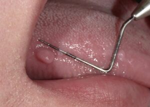 舌のひび割れは病気？自分でできるケア方法と注意したい4つの病気 イシャチョク