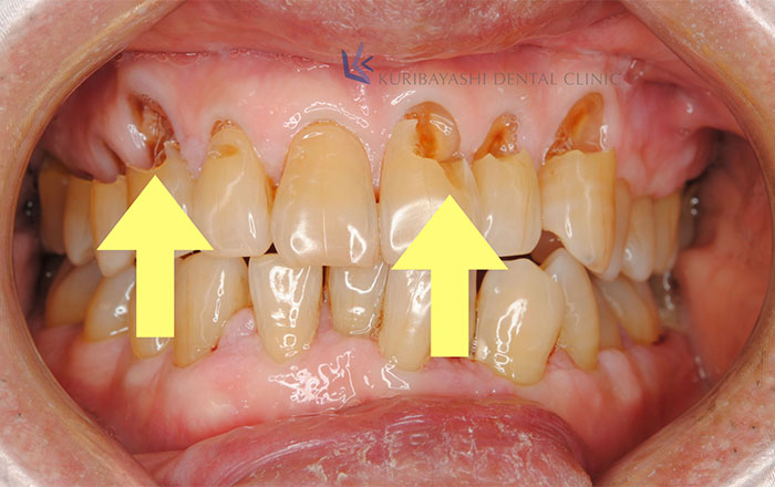 溝状舌 - Wikipedia
