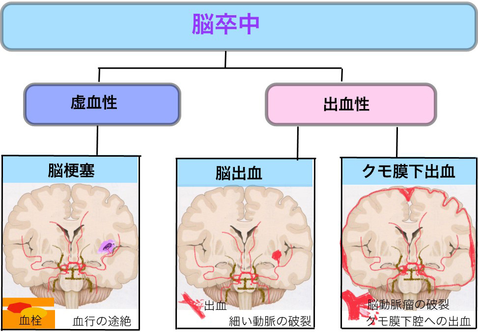 一刻も早く受診し、 後遺症を抑える治療を『脳梗塞』