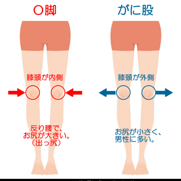 反張膝 膝の過伸展 とは？症状と対策を詳しく解説