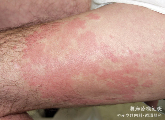 白色描記症と赤色描記症つだ小児科クリニック世田谷区 小児科一般・アレルギー科・乳幼児健診・予防接種