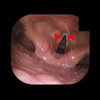 声帯結節、声帯出血: 院長ブログ