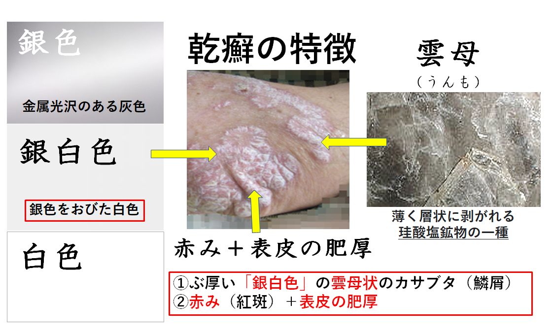 扁平苔癬の原因と感染リスクとは？発症理由と予防法を徹底解説