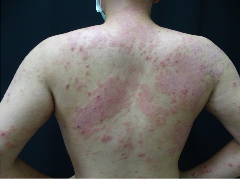たまにやってくる背中の治らない湿疹。ステロイドが効かない湿疹皮膚炎咲くらクリニック