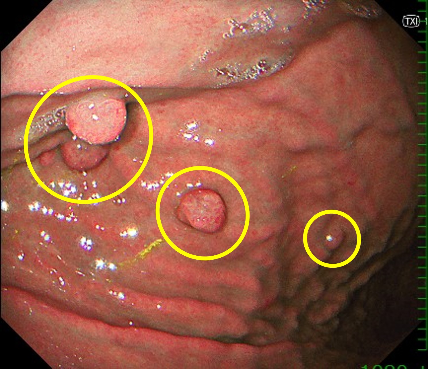 Transnasal Endoscopy.2007