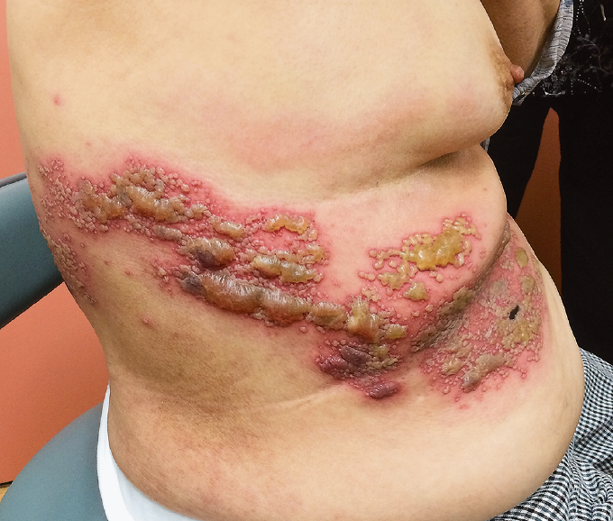 2人に1人が発症?! 帯状疱疹の初期症状 治療 ワクチンまで解説千葉県長生郡長生村のあまが台ファミリークリニック 内科 小児科 皮膚科 糖尿病内科 健康診断 予防接種