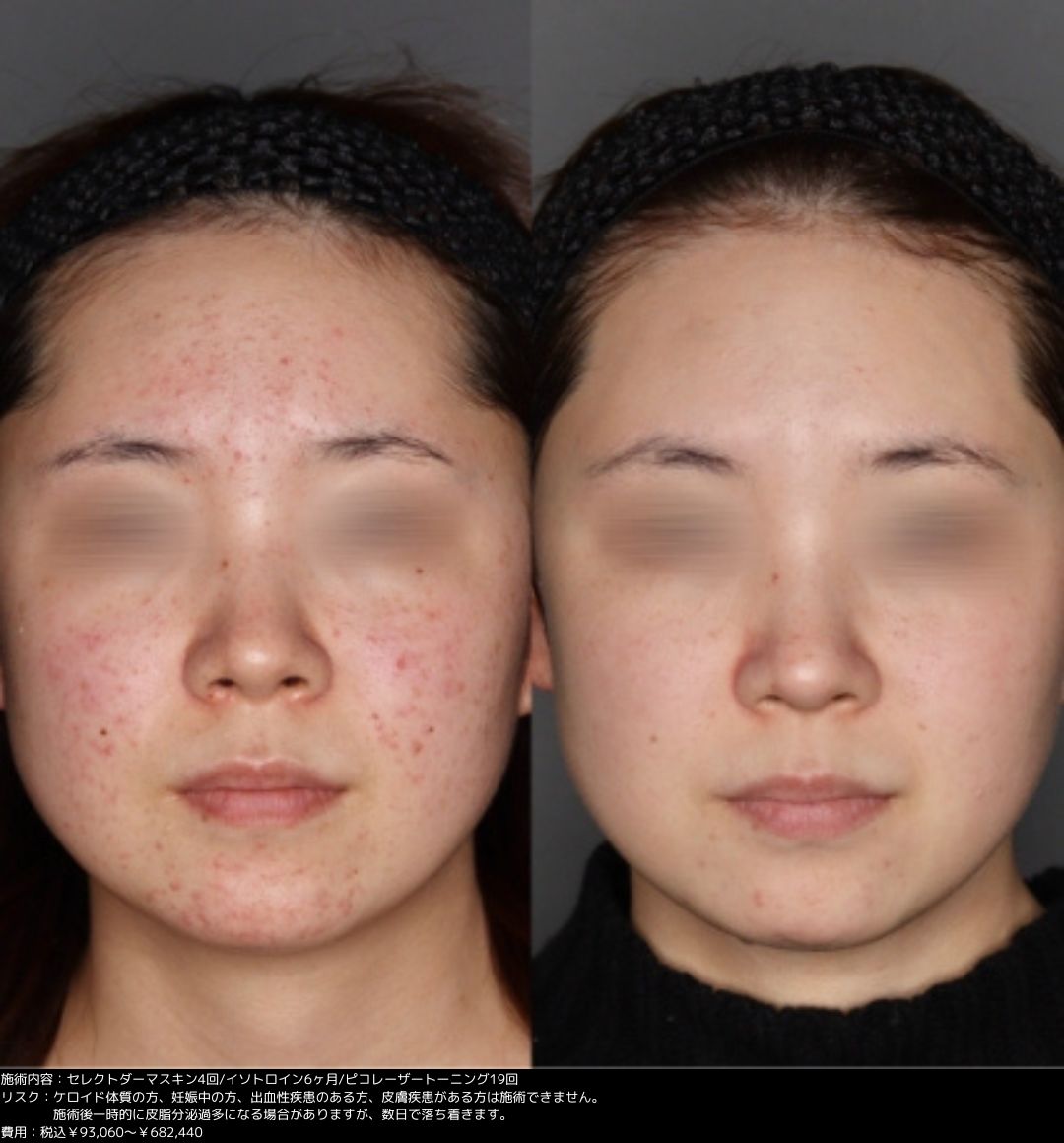 217件の「胸 ニキビ」の動画素材 ‐ 4K、HD動画クリップShutterstock