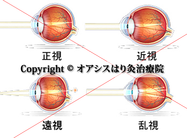 近視 遠視 弱視 乱視の視力回復A-2型トレーニング機器セット 3ｍ用: 東京視力通販 - 通販 - Yahoo!ショッピング