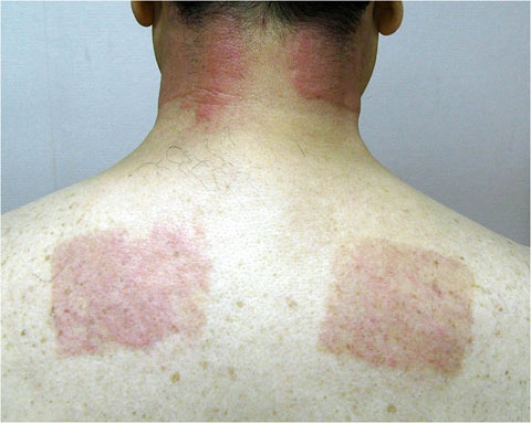 日焼け後の「まだらな皮むけ」の対処法！原因からケアのポイント美的.com