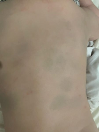 蒙古斑の消失時期と異所性蒙古斑の特徴