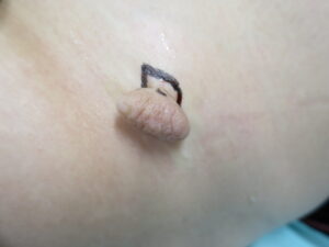 日帰り手術粉瘤・ほくろ除去で皮膚科をお探しなら はなふさ皮膚科へ