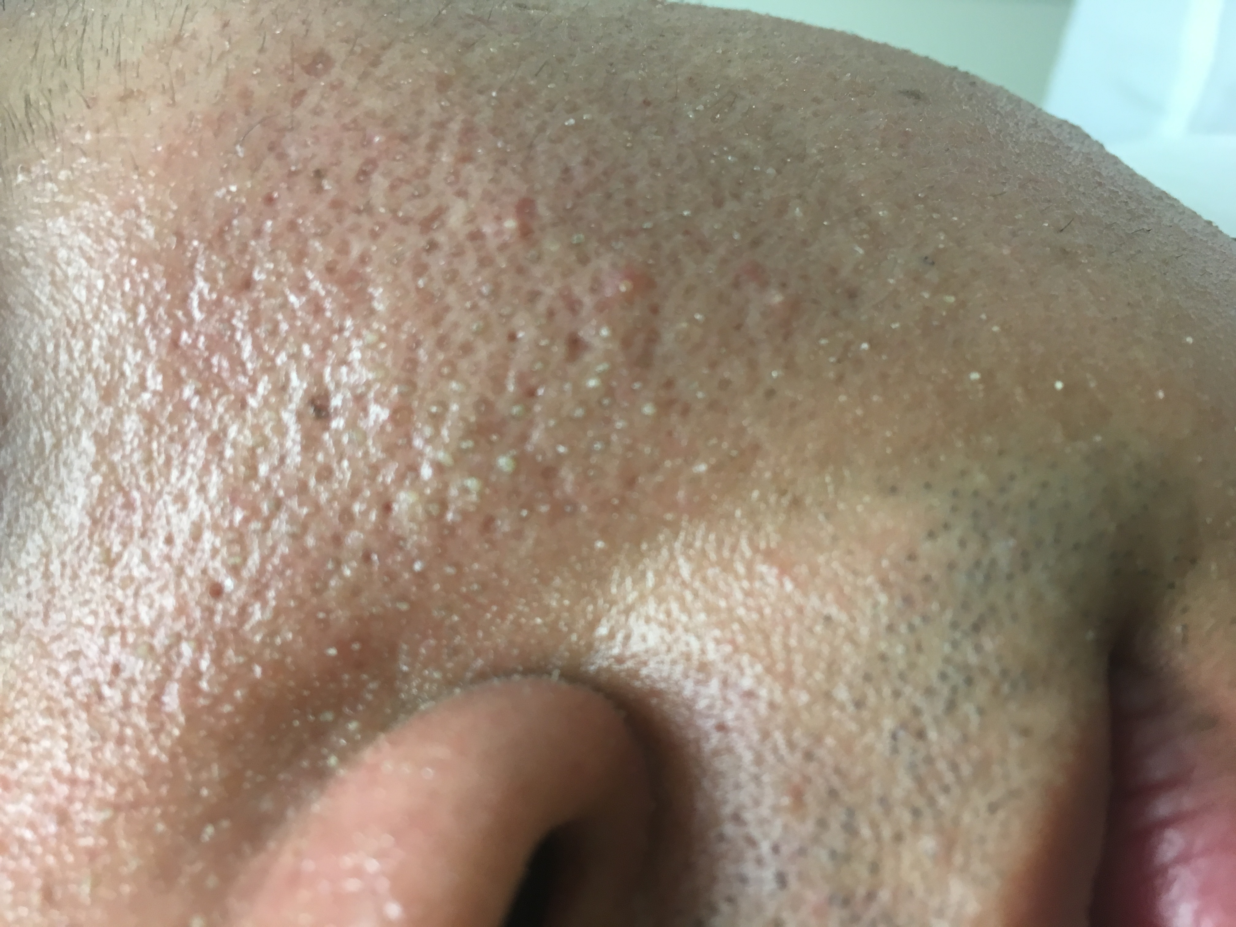 毛穴の角栓を取る前に要確認！知らずにやると逆効果