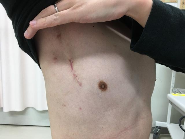 胸の傷跡心臓手術後 1 ヶ月 - 傷跡のストックフォトや画像を多数ご用意 - 傷跡, 心臓手術, 胸 - iStock