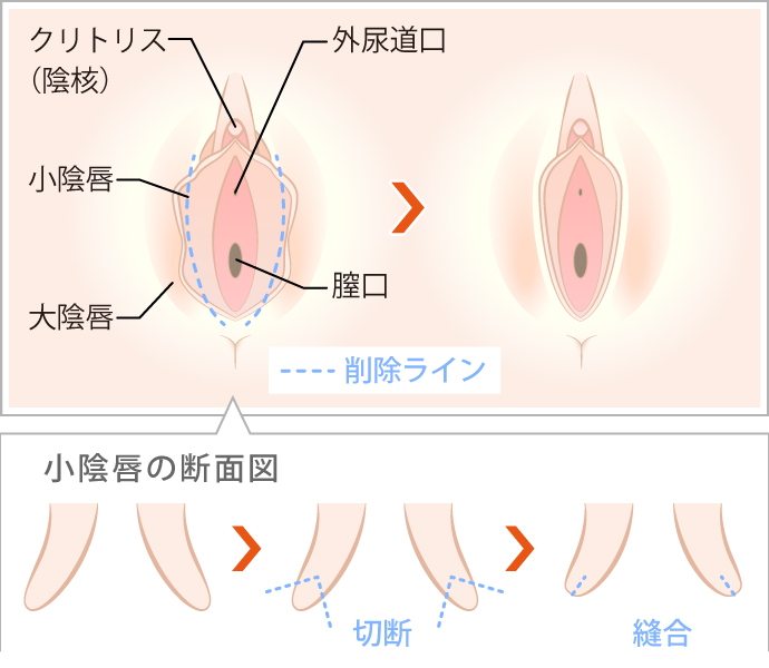 巨クリ】クリトリスがでかい！ 平均サイズや原因・対策方法を解説 |