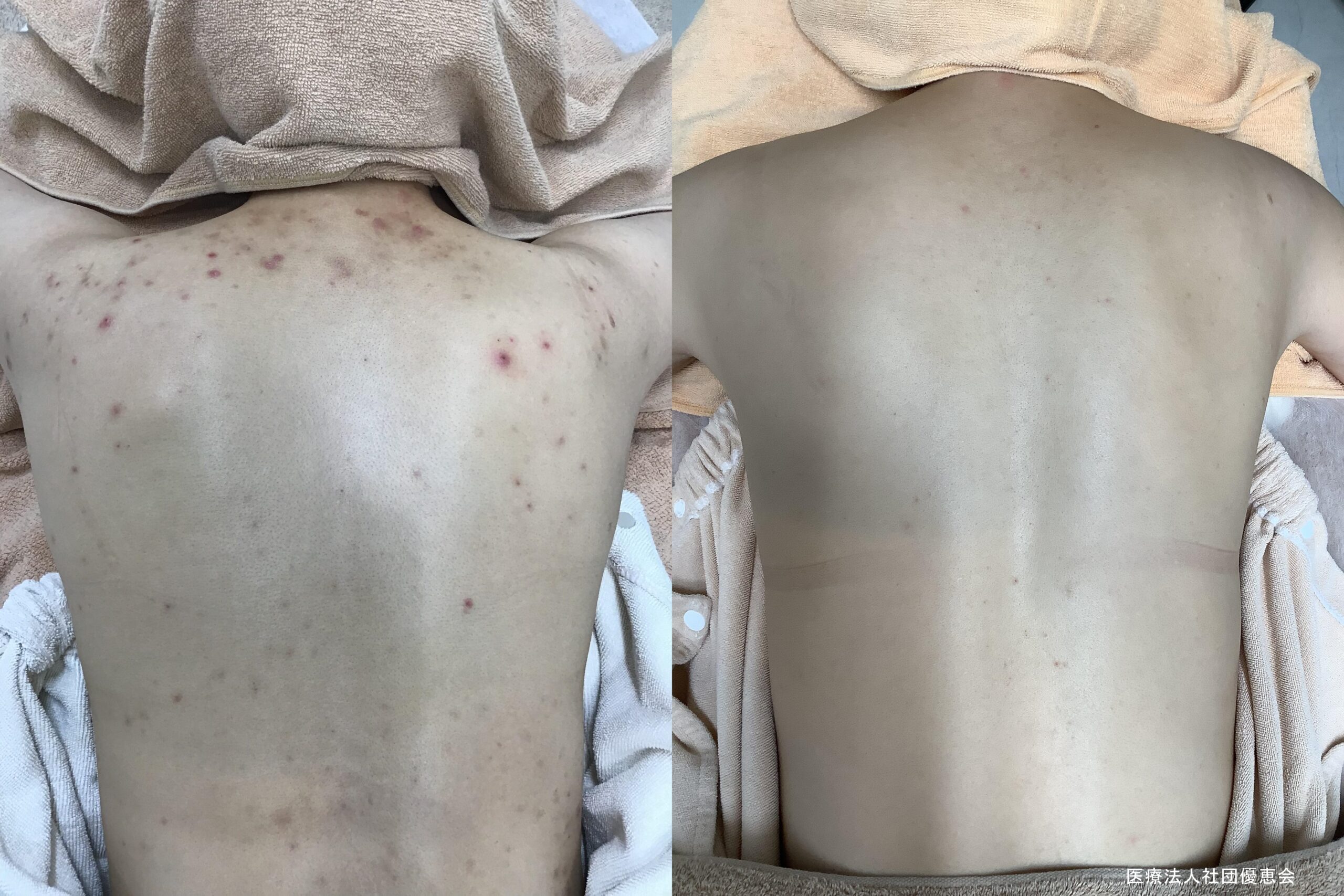 大きいニキビの原因や粉瘤との違いについて美容コラムはなふさ皮膚科・美容皮膚科 関東・関西・東海・九州エリアに16院