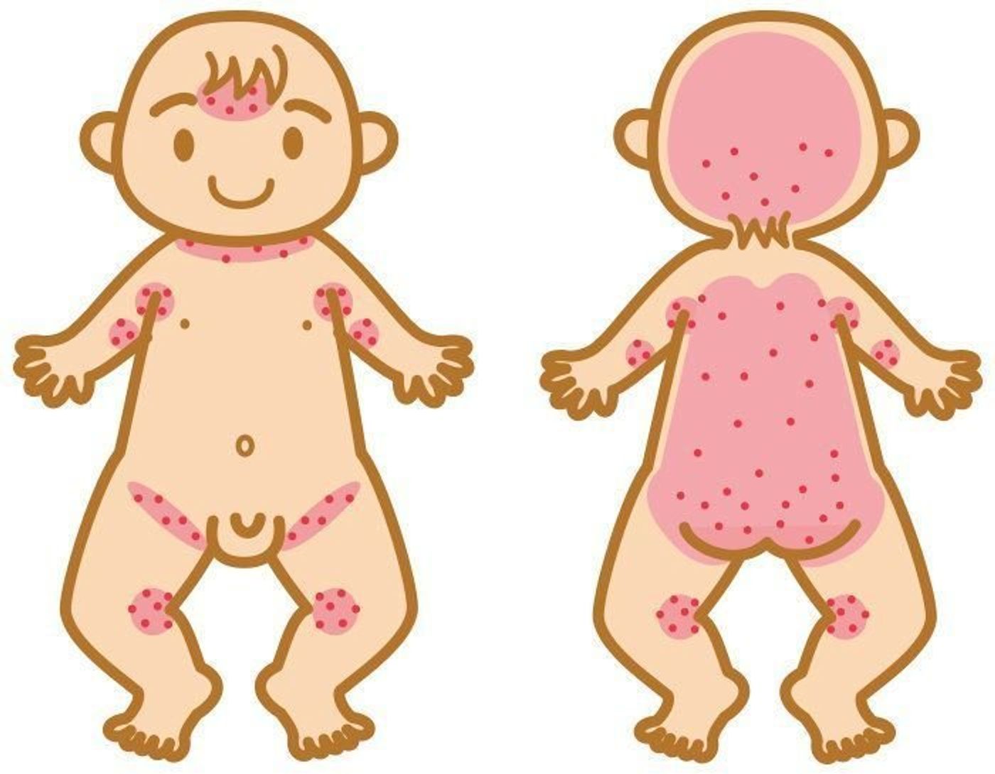 あせもの治し方は？症状や原因、適切なケア方法を解説 イシャチョク