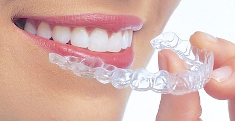 マウスピース矯正中のごはんはどうする？外食や食べ歩きの注意点も解説！ - 矯正歯科ネットプラス