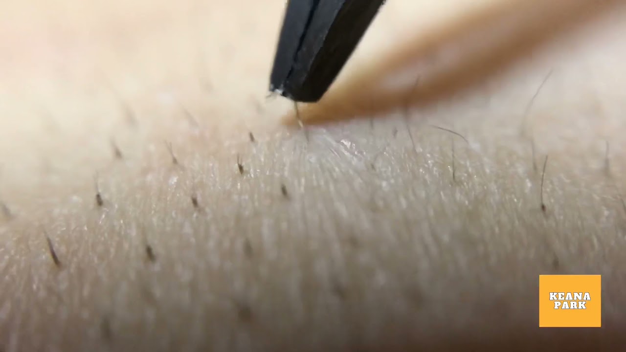 背中の角栓の対処法メンズスキンケア大学