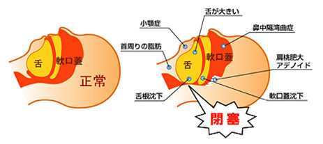 耳鳴り －気になるからだの危険信号－ │ 生活習慣病を予防する 特定非営利活動法人 日本成人病予防協会