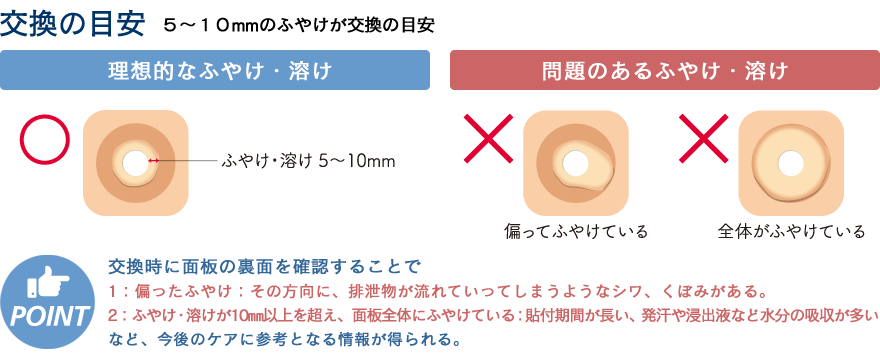 SIILストーマパウチカバーストーマ ベルトストーマ用品ストーマ パウチストーマ用サポートラップ 動画 消化器用ストーマ装具に付いている脱臭フィルターとは？– ストーマケア.net