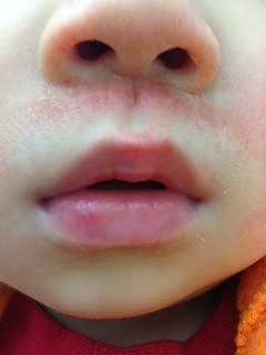 いちご鼻の即効性のある治し方！家にあるもので中学生でも簡単に鼻の黒ずみをとれる？ANS. magazine