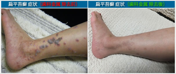 扁平苔癬 - 14. 皮膚疾患 - MSDマニュアル プロフェッショナル版