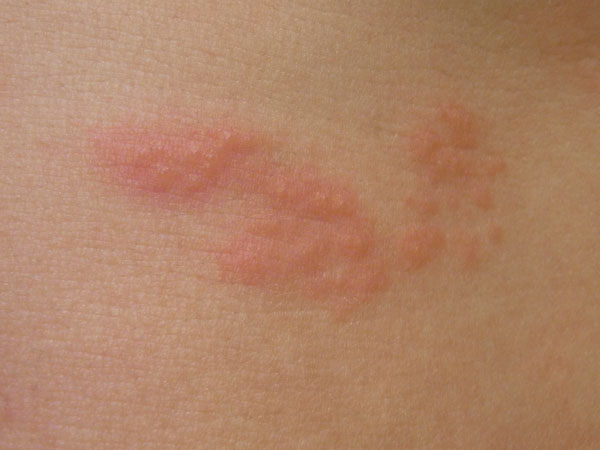 帯状疱疹 - 巣鴨千石皮ふ科