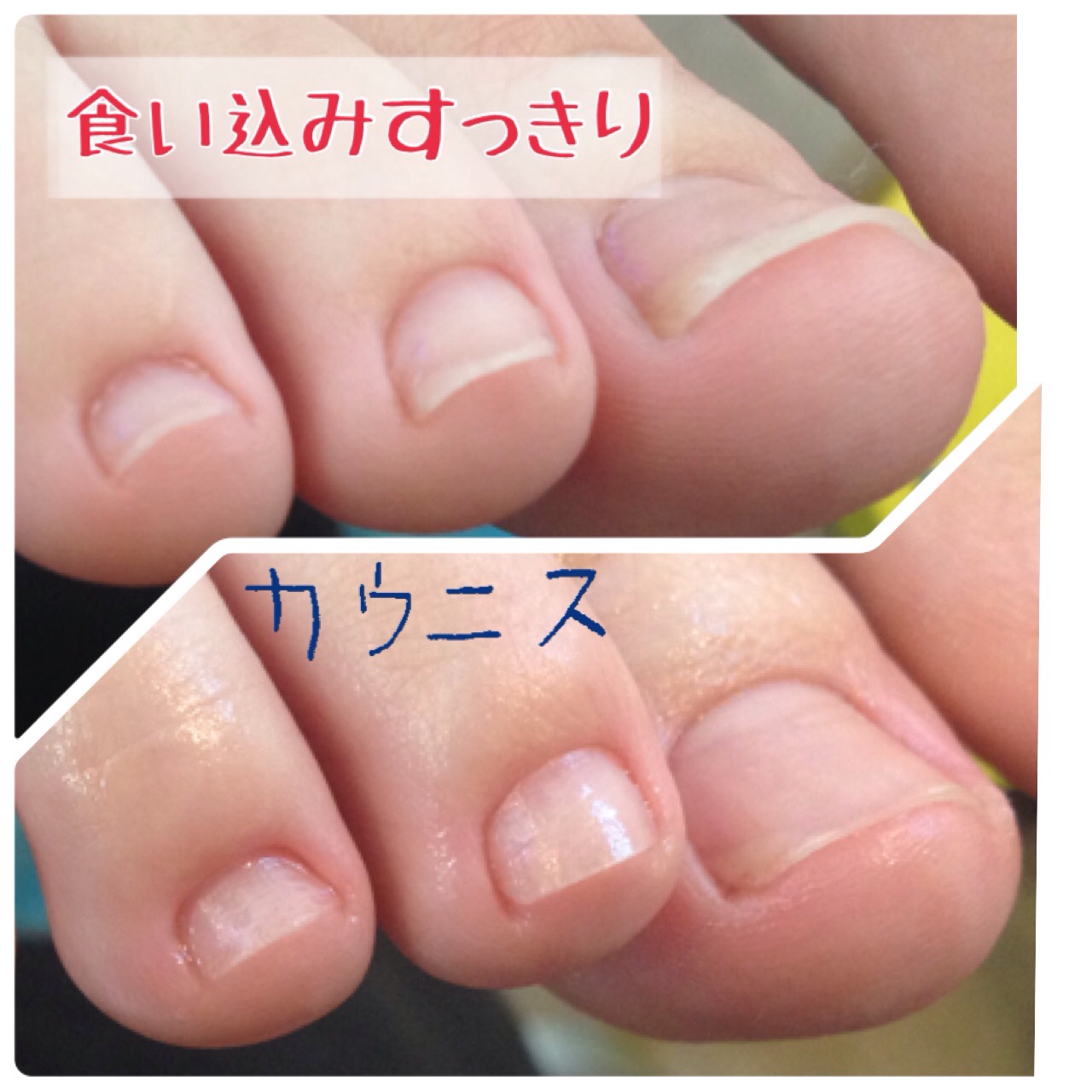 セルフケア 巻き爪編巻き爪巻き爪専門 自由が丘ひばり整爪院 東京都世田谷区