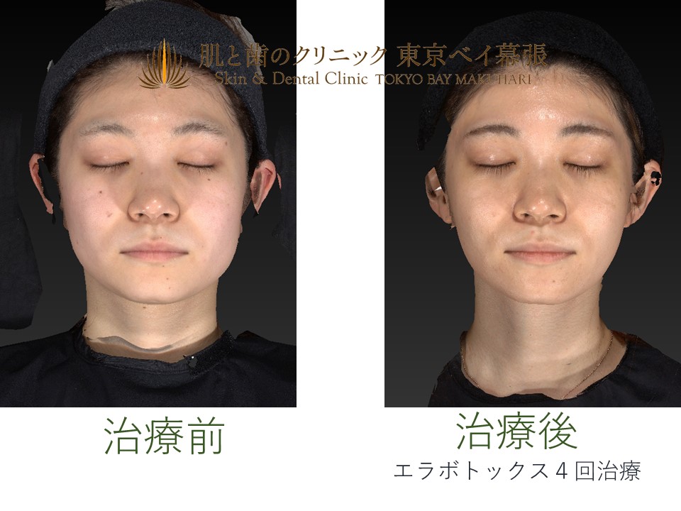 エラボトックス効果はいつから?効果がない人もいるのはなぜ?公式 ASTRA BEAUTY CLINIC アストラビューティクリニック 美容外科 ・美容皮膚科・形成外科渋谷駅前