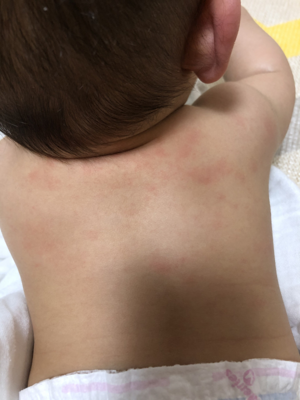 背中の湿疹について 赤ちゃんの病気・ケガ ベビーカレンダー専門家相談