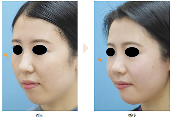 Before after 頬骨管理＋美人肩管理 を受けられたお客様WEBEAUTY大阪店