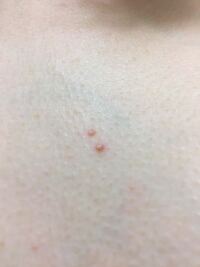 腫れもの・できもの治療粉瘤・脂肪腫など静岡静脈瘤クリニック