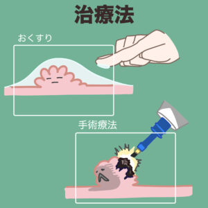 尖圭コンジローマ治療の症例No.1 – メンズ形成外科青山セレス&船橋中央クリニック