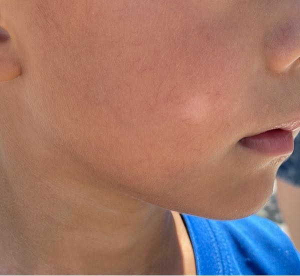 単純性粃糠疹 はたけ保険適用 ヒフメド皮フ科専門オンライン診療