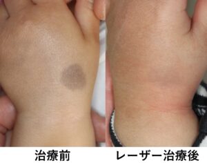 症例解説 青あざ 異所性蒙古斑 のレーザー治療と経過赤ちゃん・子供のあざ治療なら最新レーザー治療×形成外科専門医の大阪梅田形成クリニック