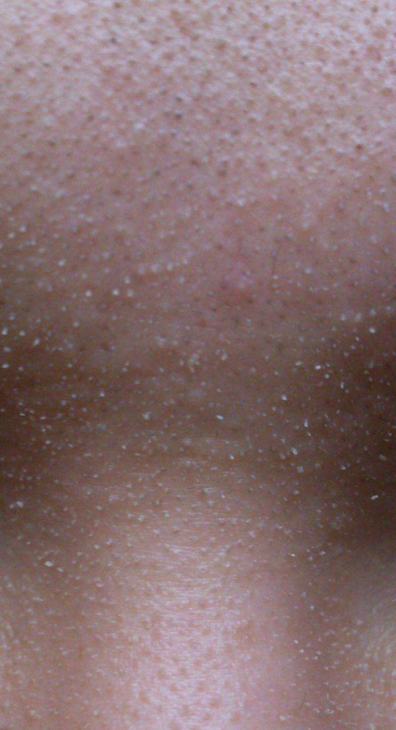 プチ角質培養その後～皮剥けがおさまる～ケミ断ち・角質培養・無添加オーガニックコスメで若返り＆アンチエイジング実践中！！～LASTINGBEAUTY～