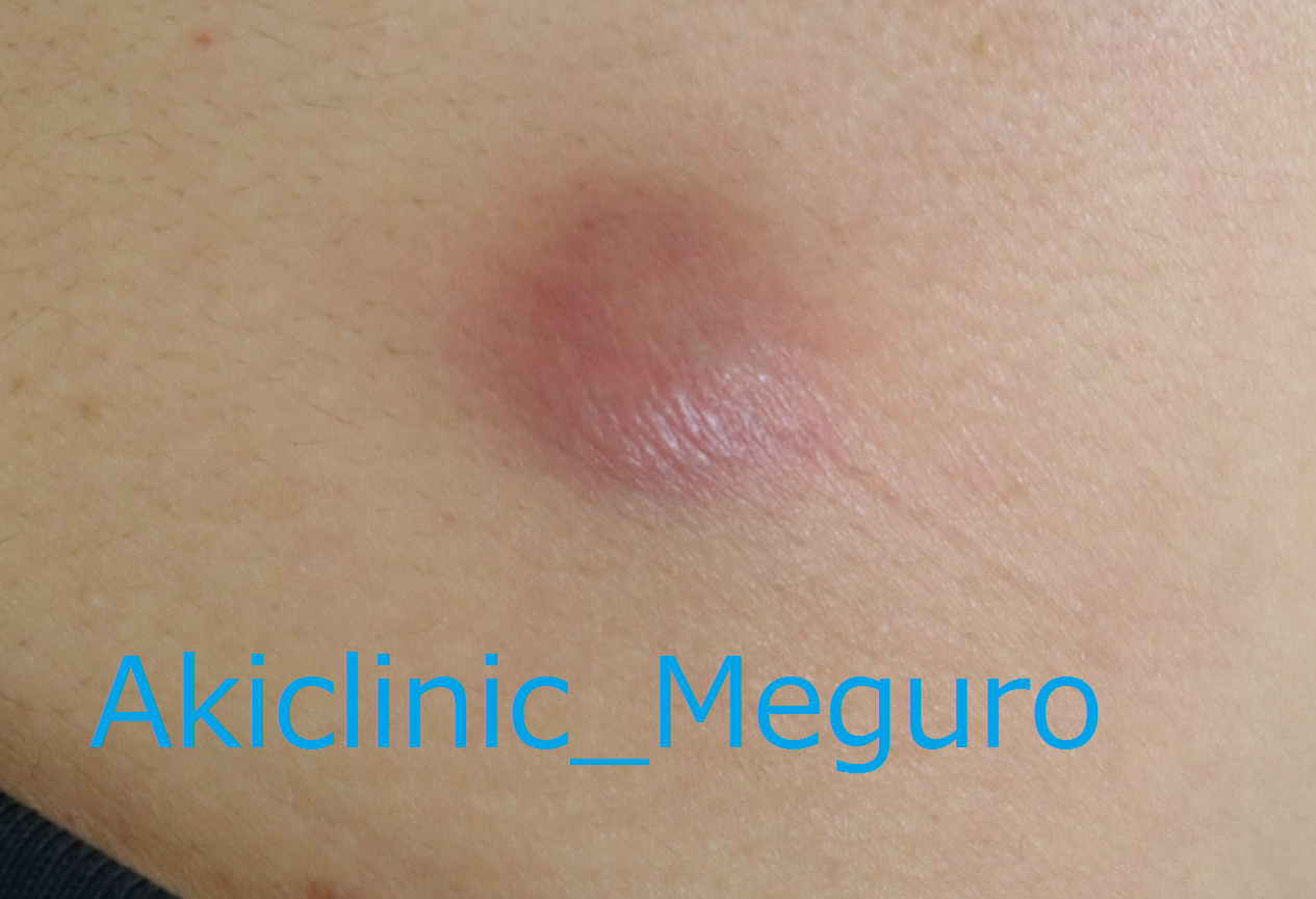 重症ニキビ治療についてニキビ治療・ニキビ跡治療の東京イセアクリニック