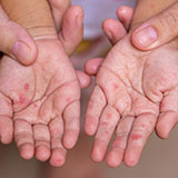 伝染性紅斑 りんご病ほりき皮膚科クリニック