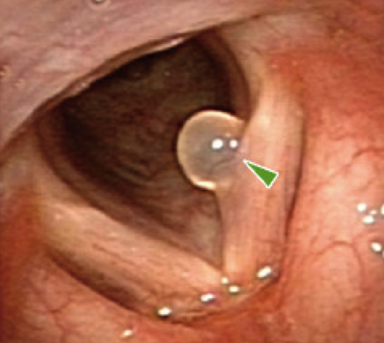 咽頭がん・食道がんについて目黒区自由が丘駅から徒歩2分、自由が丘消化器・内視鏡クリニック