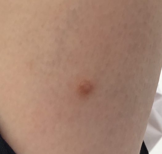 日帰り手術粉瘤・ほくろ除去で皮膚科をお探しなら はなふさ皮膚科へ