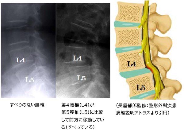 脊柱の圧迫骨折 せきちゅうのあっぱくこっせつ について福岡の弁護士による後遺障害・等級認定サポート