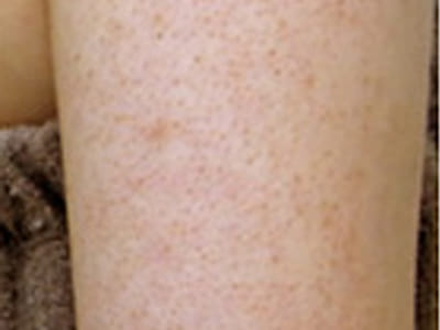 二の腕のブツブツは毛孔性苔癬！？原因と治し方や効果的な薬も紹介ハダメディア by BIHADADO.TOKYO