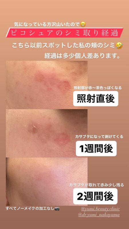 シミ取り後の赤みと色素沈着福岡市城南区の美容皮膚科タケダビューティークリニック