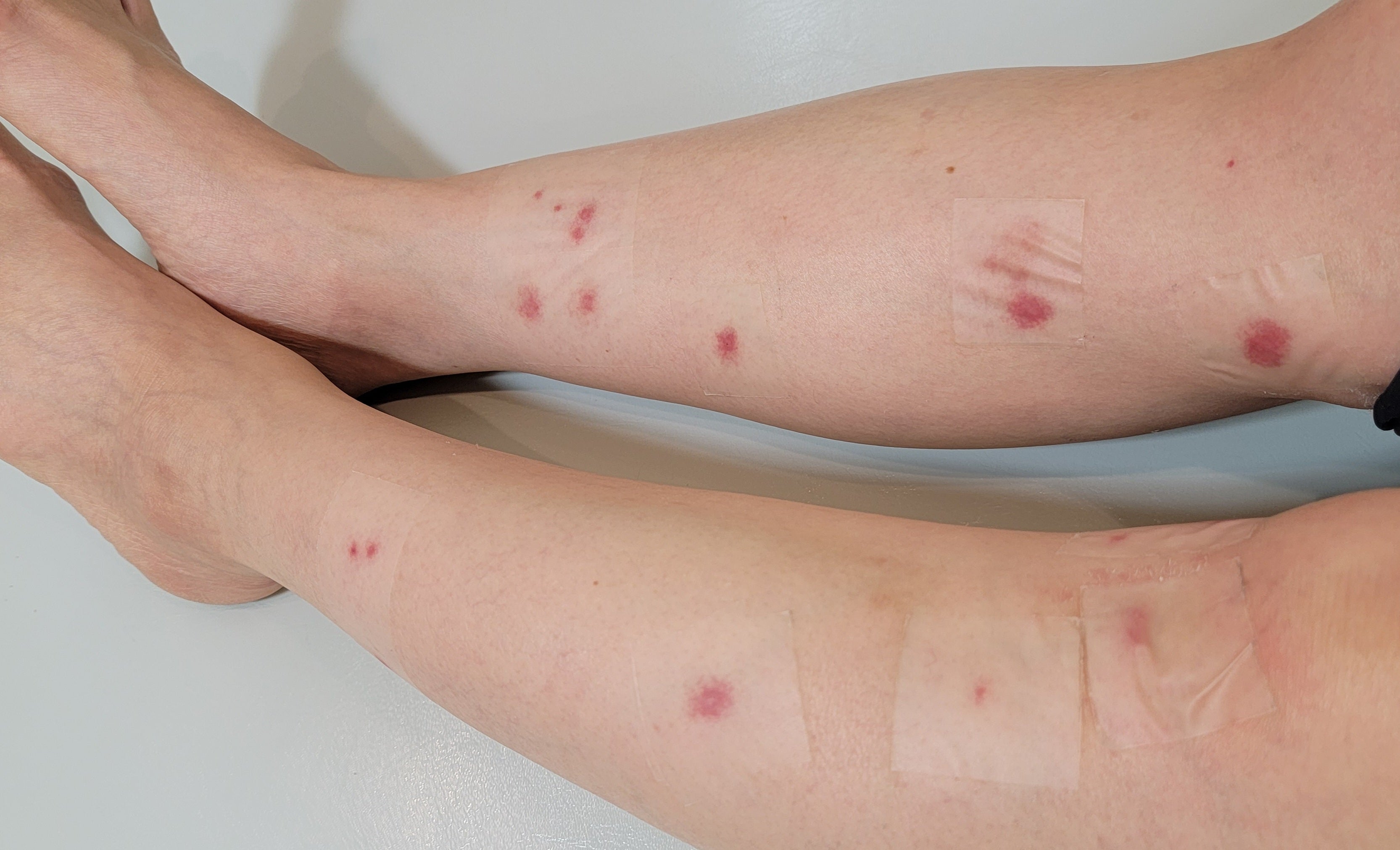 ブヨ刺された跡」の写真素材8件の無料イラスト画像Adobe Stock