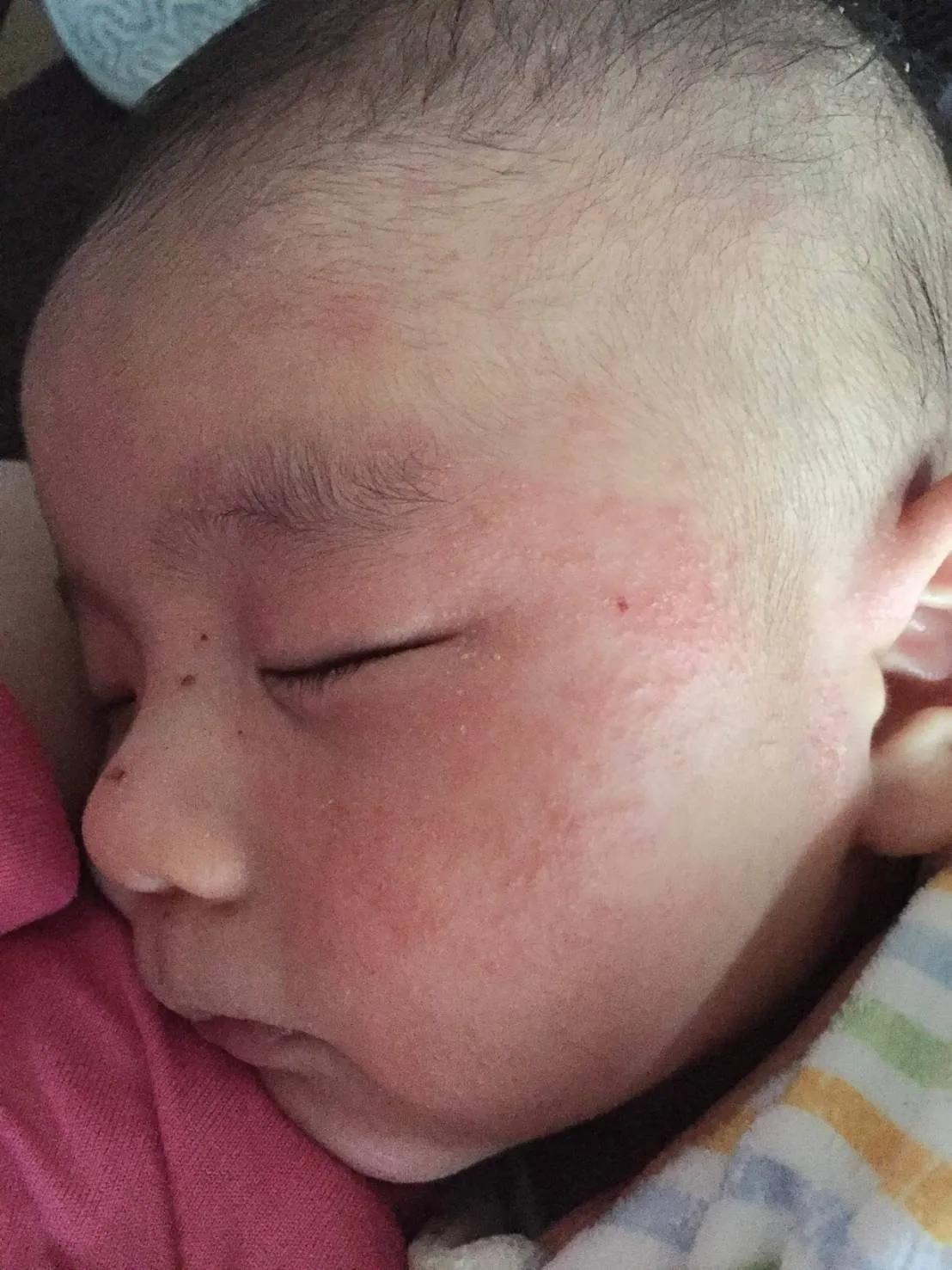 desquamation落屑野田市 小児科 千葉県 こどもの花粉症 こどもの漢方 喘息 アトピー性皮膚炎 アレルギー 結節性痒疹たんぽぽこどもクリニック