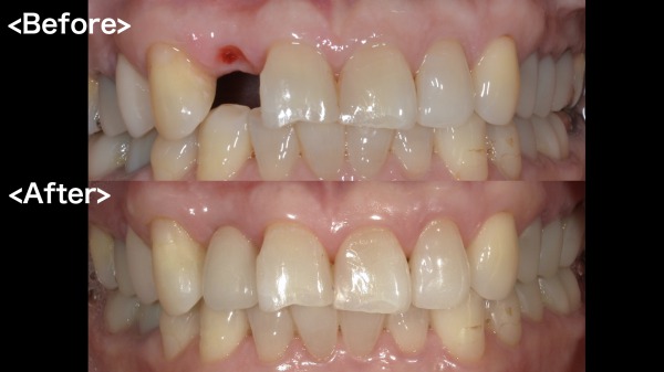症例 抜歯即時インプラント埋入治療で不揃いの前歯を1日で美しい見た目に千葉県柏市の歯医者「ウィズ歯科クリニック」