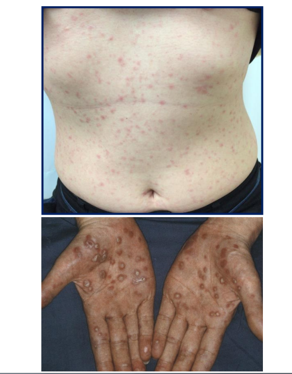 梅毒の症状は？掌や足の裏に発疹ができたら要注意 - ルナレディースクリニックのメディア