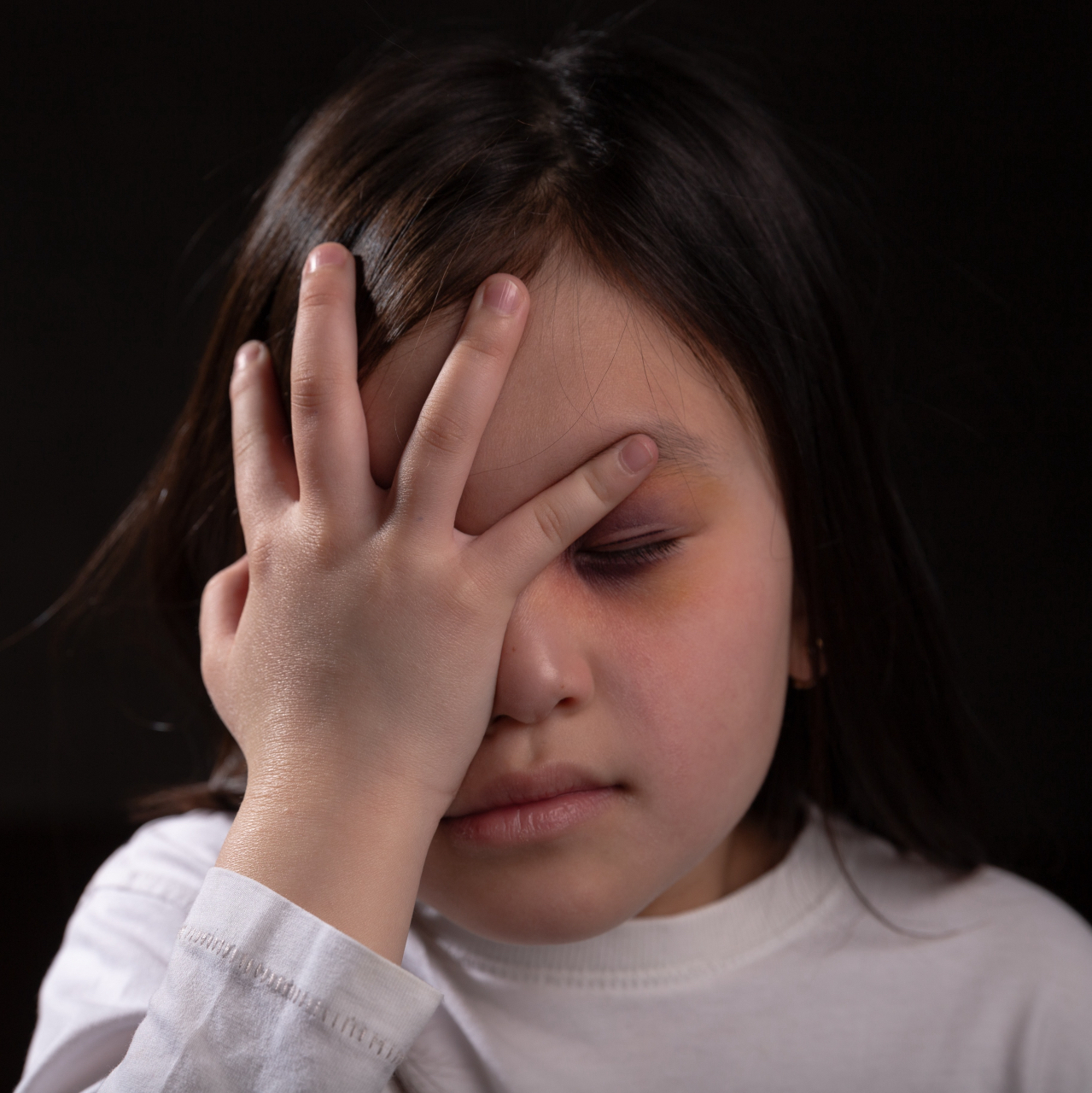 目をぶつけて、まぶたが腫れて内出血している赤ちゃん 2歳3か月、女の子、日本人 の写真素材95183607- PIXTA