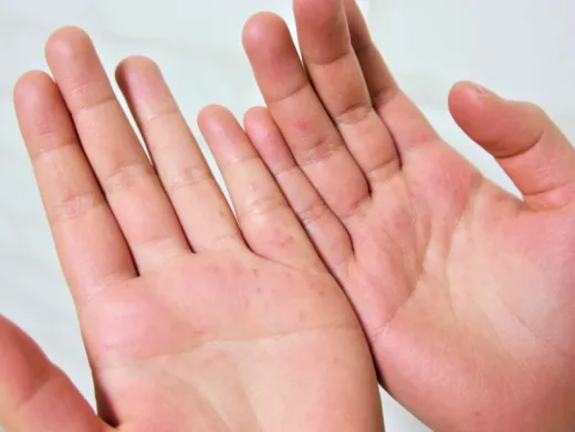 アトピー性皮膚炎の経過写真一覧│新京橋治療院